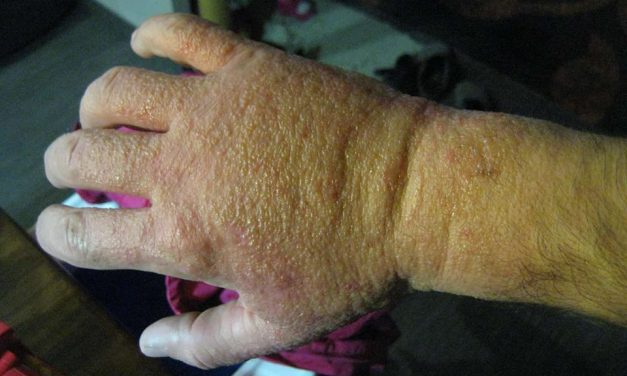Urticaria familiar por alimentos y por contacto con plantas