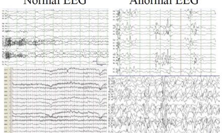 EERR. Encefalopatía epiléptica infantil temprana por mutación en SLC25A22 y Síndrome Lennox-Gastaut. La historia de Alejandro.