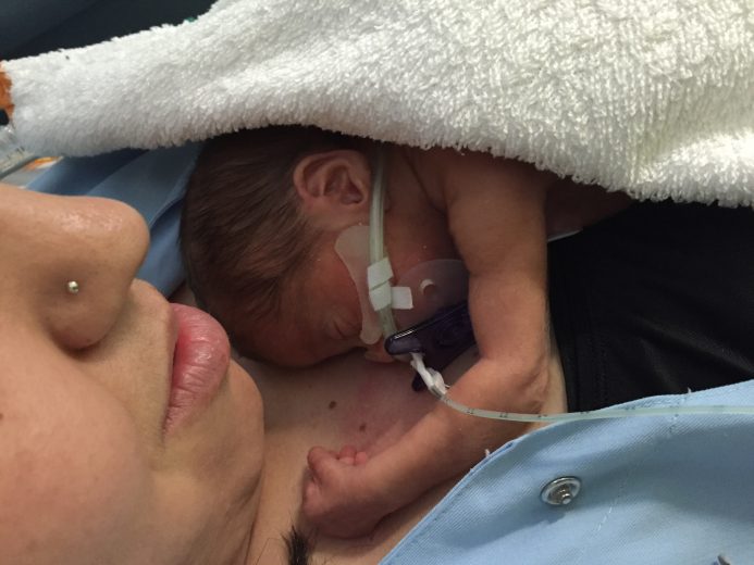 Bebé con sonda haciendo piel con piel con su madre. Leo tiene Parálisis cerebral por un parto prematuro