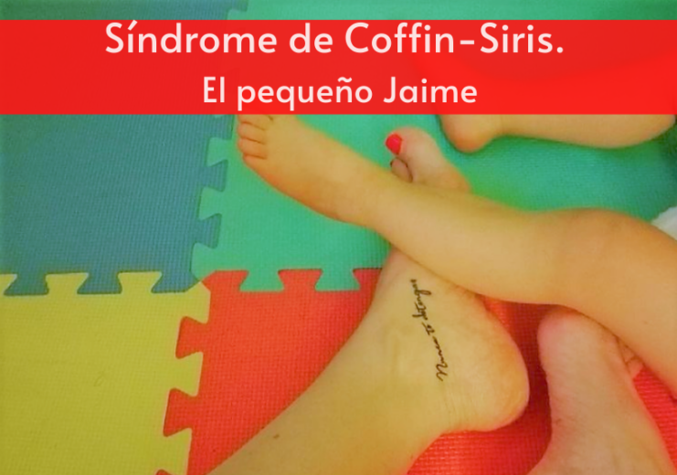 Síndrome de Coffin-Siris. El pequeño Jaime